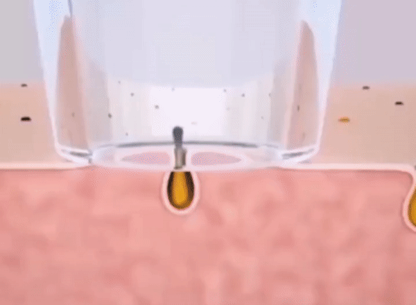 Blackhead Remover Pimple Comedone Extractor Tool